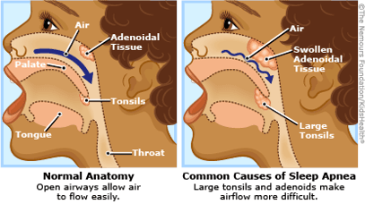 kids airway